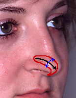 dent-in-nose-cartilage