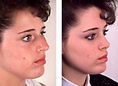 Plastic surgery (cosmetic surgery) before and after photograph