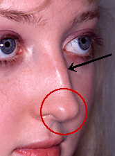cartilage-bump-on-tip-of-nose