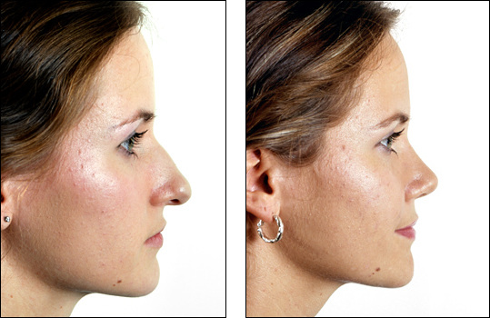 primary rhinoplasty hump long nose wide tip