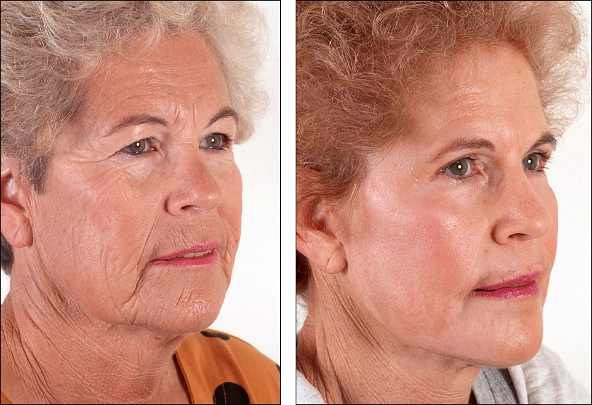 face lift and chemical peel