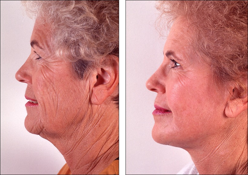 face lift and chemical peel