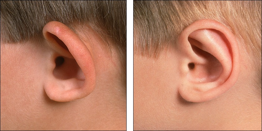 ear surgery