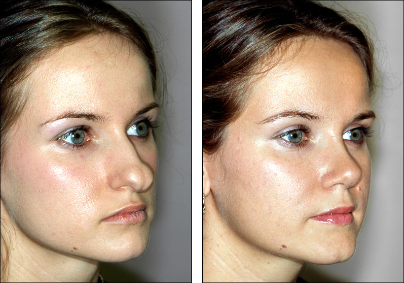 Dr. Steven Denenberg's facial plastic surgery before and afters Rhinoplasty, large tip noses 1