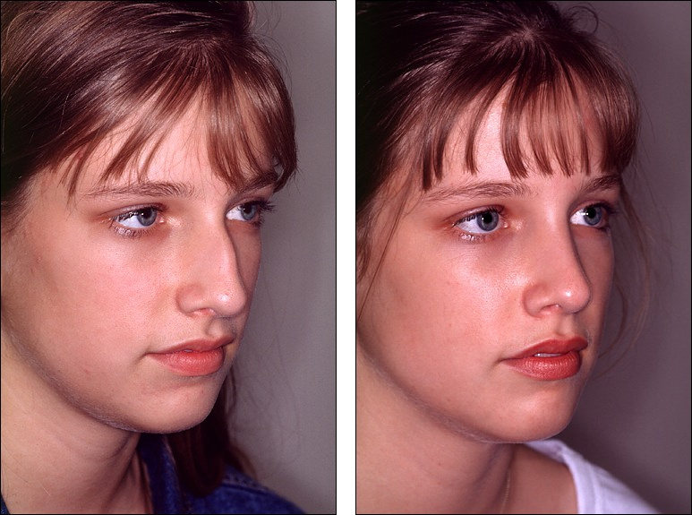 Dr. Steven Denenberg's facial plastic surgery before and afters Rhinoplasty, noses with humps 14
