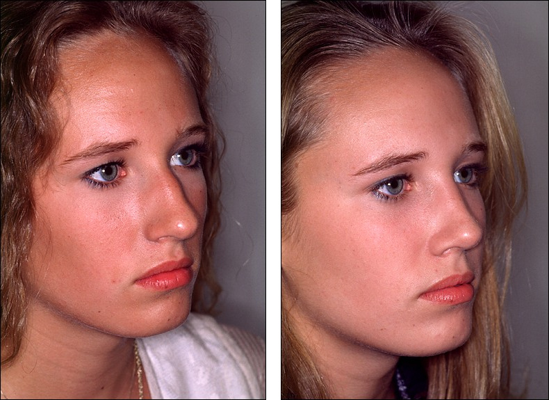 Dr. Steven Denenberg's facial plastic surgery before and afters Rhinoplasty, noses with humps 3