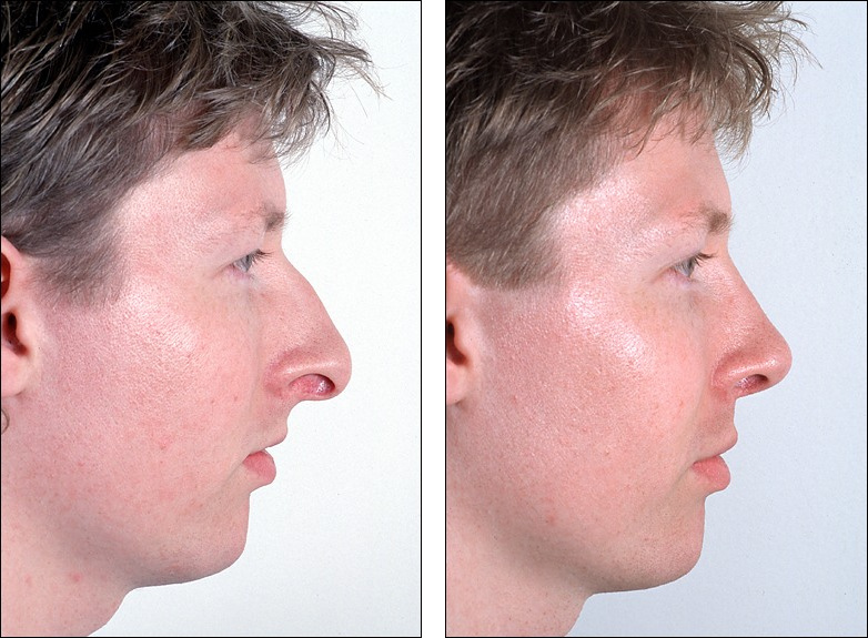 Dr. Steven Denenberg's facial plastic surgery before and afters:  Rhinoplasty, large tip noses #8