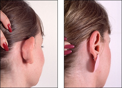 Ear Surgery Plastic Surgery Photos