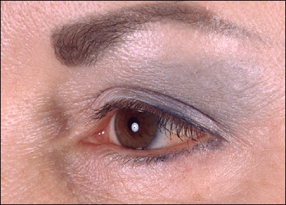 Brown patch on upper eyelid