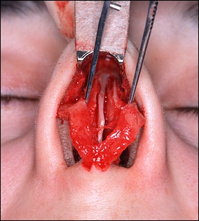 Rhinoplasty tutorial, Nasal septum: page 1 - FacialSurgery.com