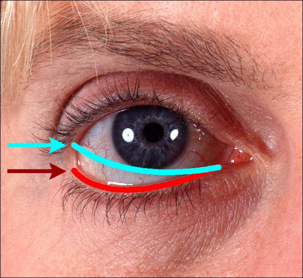 Eyelid surgery tutorial, Lower eyelids II: page 10, Enlarged