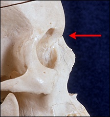Rhinoplasty tutorial, The nasion: page 1 - FacialSurgery.com